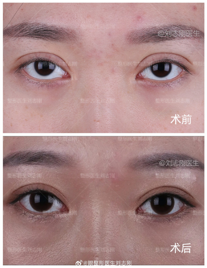刘志刚双眼皮修复案例