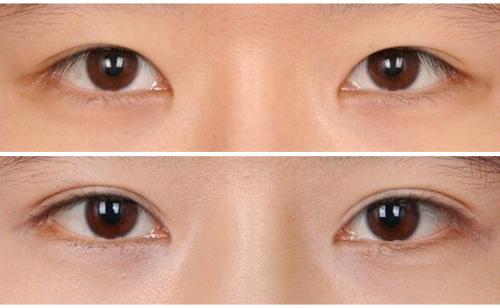 全切的双眼皮能修复吗？全切双眼皮修复的条件是什么？