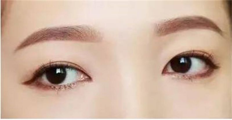 王振军和赵惠春双眼皮修复眼睛整形谁做得好？