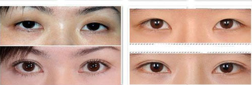 做完双眼皮之后多长时间可以做双眼皮修复？