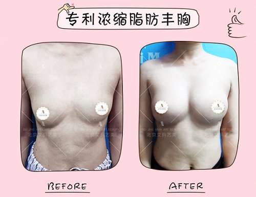 北京自体脂肪丰胸哪个医生做的好？专利技术都有哪些？