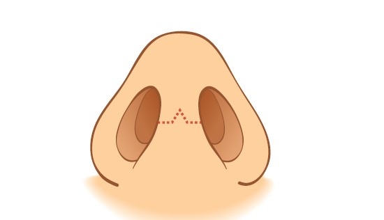 鼻整形奥秘（五）：隆鼻手術的方式有哪些? 如何選擇適合自己的手術方式呢?