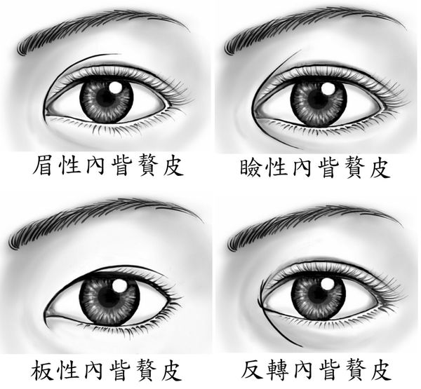 眼整形解密（四）：双眼皮皱褶内侧起点/内眦(medial canthus)的型态有哪些? 什么是蒙古折？