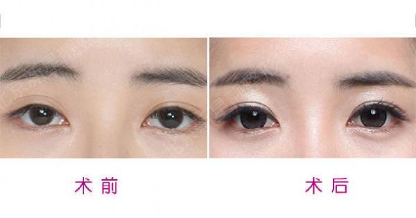 中国最好的双眼皮眼部整形眼修复专家：闫迎军（简介、案例、预约）