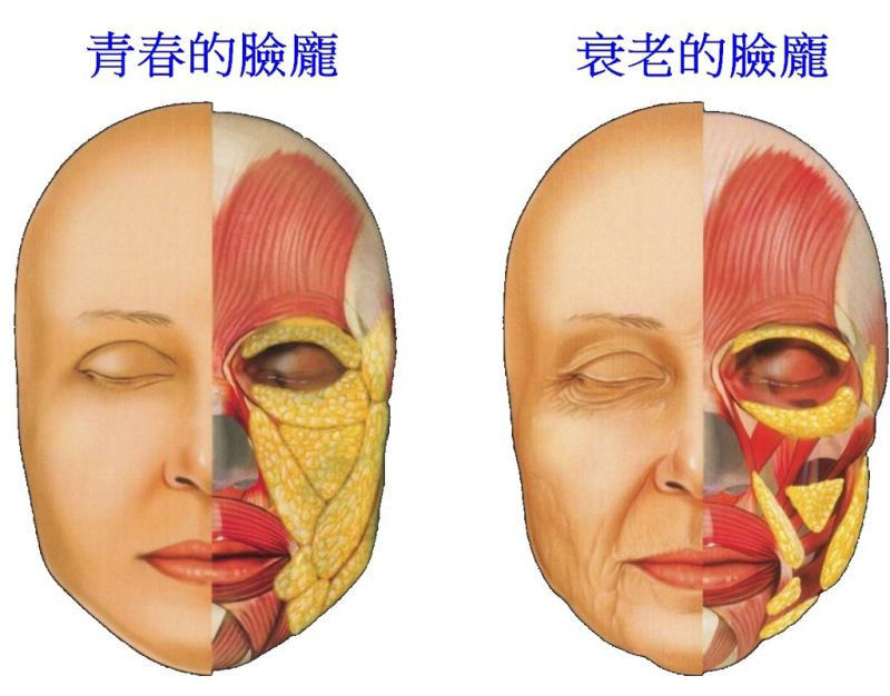 脸部衰老的关键是什么? 自体脂肪丰全脸的主要关键位置?