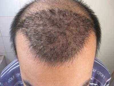 植发缘何成为整形新宠？中国男性脱发率高达20%