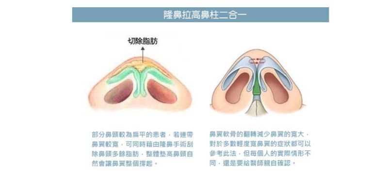 最后一种缩鼻翼的方式,则是藉由隆鼻手术的植入物来撑高鼻柱与鼻头