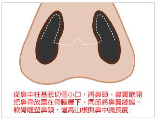 哪些人适合韩式隆鼻？韩式隆鼻和别的隆鼻方式优点有哪些？