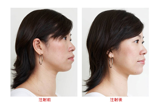玻尿酸适应部位：下巴额头太阳穴泪沟鼻子 哪些人不能注射玻尿酸？