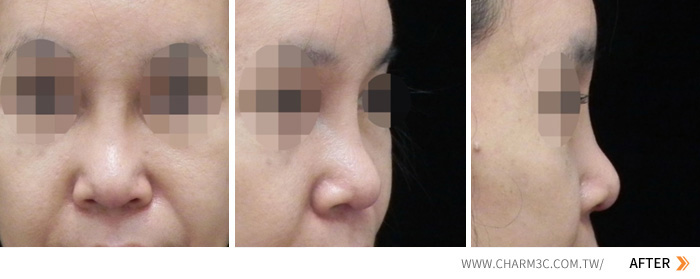 隆鼻失败之两次L型鼻手术后产生荚膜挛缩的鼻雕重置手术