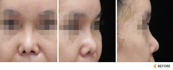 隆鼻失败之两次L型鼻手术后产生荚膜挛缩的鼻雕重置手术