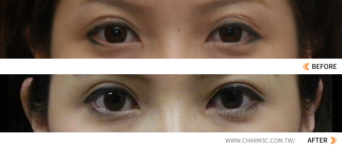 割双眼皮手术后产生三眼皮怎么修复？