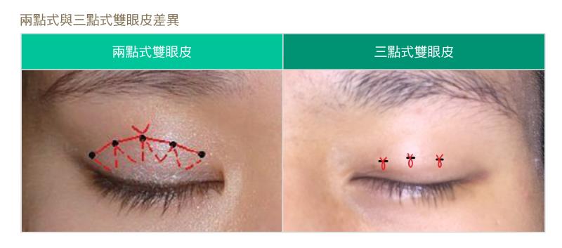 双眼皮缝合术（埋线双眼皮）两点式双眼皮和三点式双眼皮