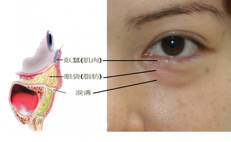 眼袋形成的原因是什么？眼轮匝肌筋膜层松弛