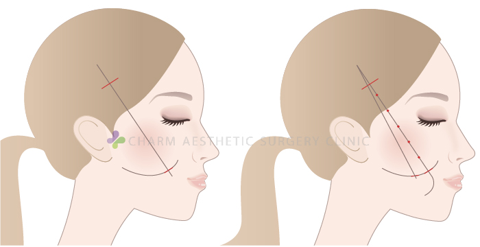 改善脸颊及火鸡脖子最有效的方法：筋膜下拉皮(SMAS拉皮)
