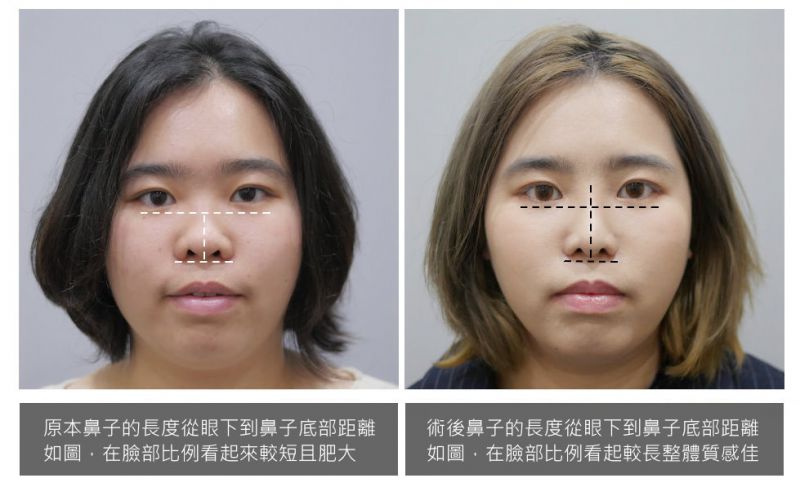 女士三段式隆鼻、鼻头塑型、敲鼻骨真实案例前后对比图