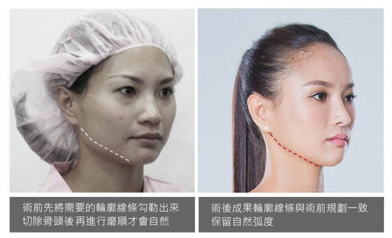脸部轮廓雕塑颧骨削骨、下颚骨角削骨案例术前术后照片对比