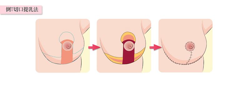 乳房下垂有哪几种手术改善方式？轻度中度重度乳房下垂矫正