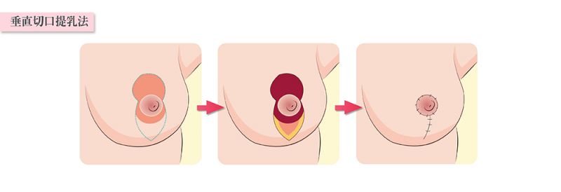 乳房下垂有哪几种手术改善方式？轻度中度重度乳房下垂矫正
