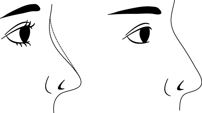 什么的鼻型才是完美鼻子？鼻子的长度与高度的比例约为3:2