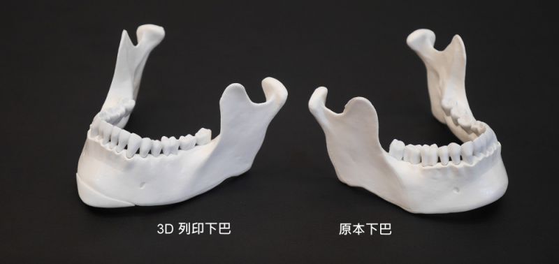 3D下巴整形手术-3D列印垫下巴手术 有什么优点？