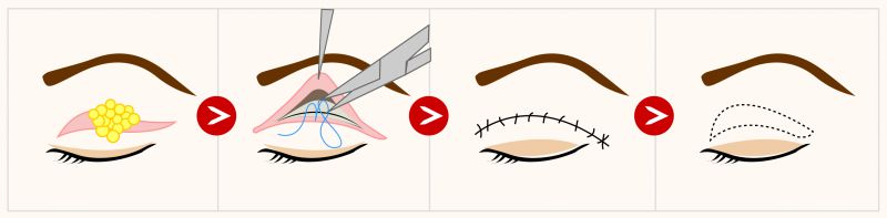 什么是双眼皮手术？伤口会很大吗？缝双眼皮手术可以解决那些眼睛问题？