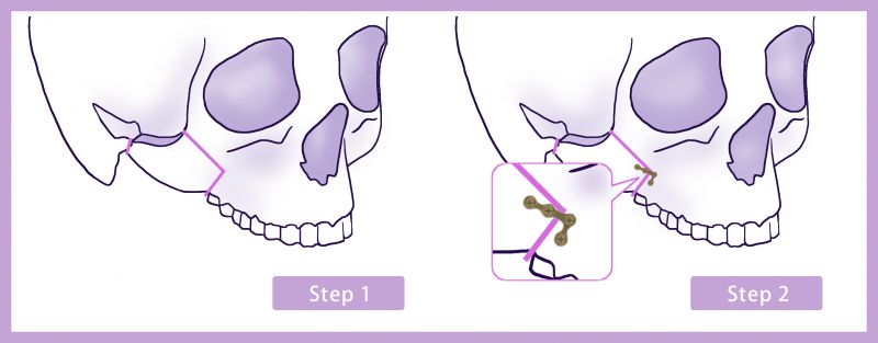颧骨缩小术内推颧骨削骨手术方法介绍