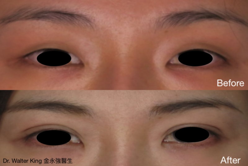 缝双眼皮（埋线双眼皮）可以保持永久双眼皮吗？