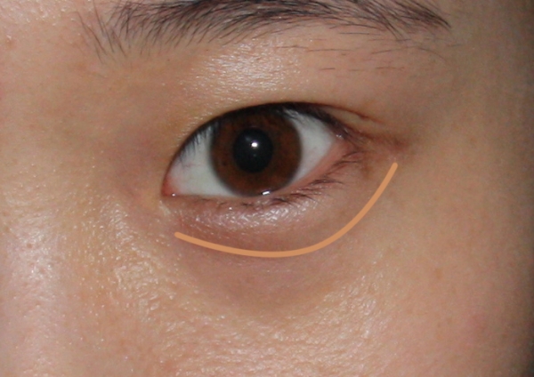 黑眼圈有哪三大类型？遗传黑眼圈和老化引起的黑眼圈怎么解决？