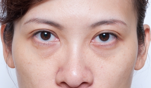 黑眼圈有哪三大类型？遗传黑眼圈和老化引起的黑眼圈怎么解决？