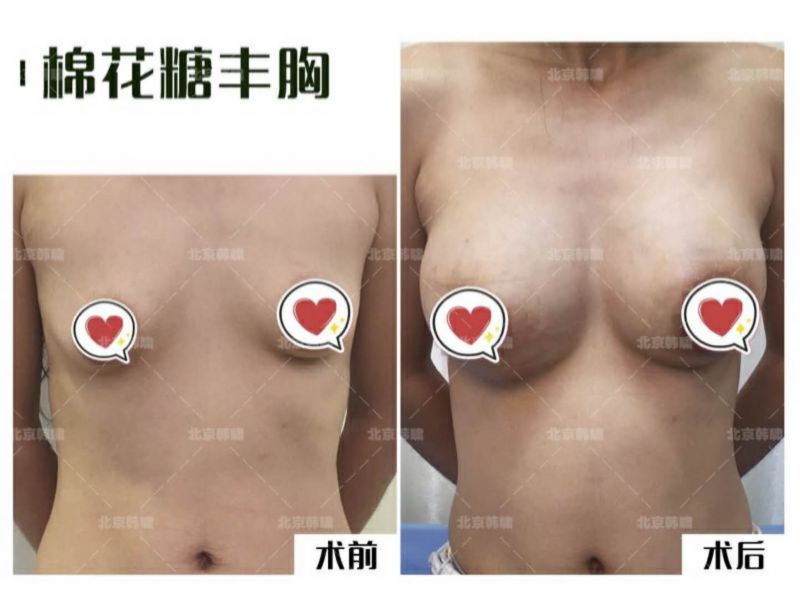 创伤最小的丰胸专利手术：棉花糖丰胸（局部麻醉）