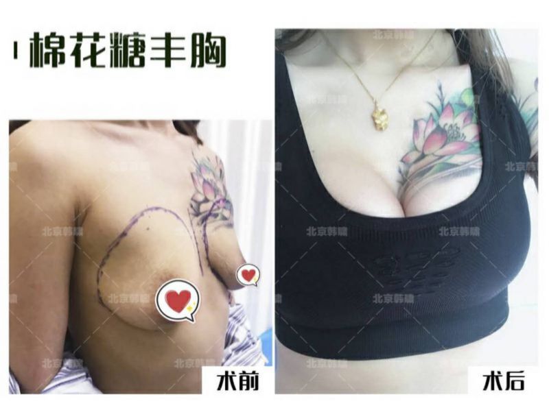 创伤最小的丰胸专利手术：棉花糖丰胸（局部麻醉）