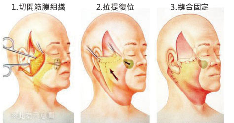 中下脸拉皮手术包括哪些部位？中脸拉皮中下脸拉皮颈部拉皮