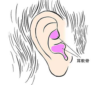 自体耳软骨隆鼻取出方法和切口位置在哪里？