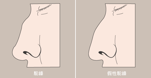 驼峰鼻？你有驼峰鼻吗？驼峰鼻怎么办？驼峰鼻矫正术