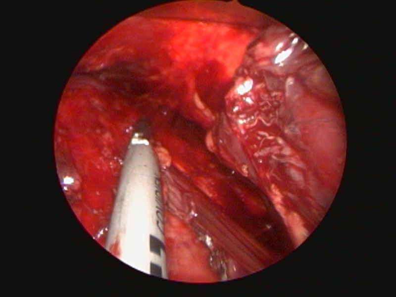 隆胸手术创新应用内视镜搭配无线超音波刀优点有哪些？