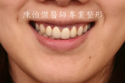 咬合不正对嘴形以及笑容的影响(第三型咬合不良、戽斗、牙龈外露)有哪些？