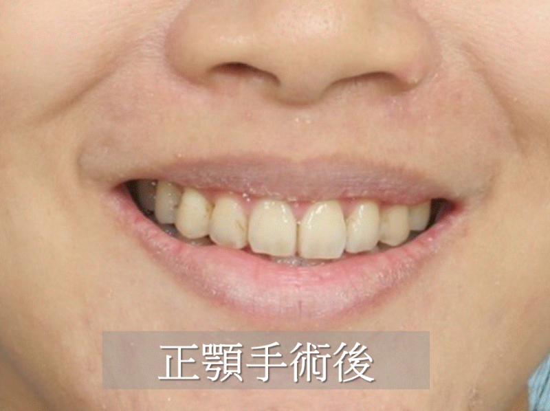 正颚手术对嘴形及笑容的改变(牙龈外露)有哪些？