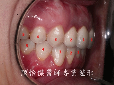 咬合不正对嘴形以及笑容的影响(第三型咬合不良、戽斗、牙龈外露)有哪些？
