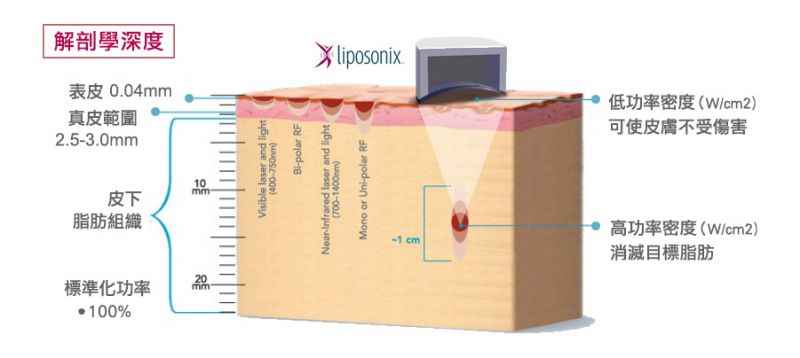 Liposonix立塑聚焦音波溶脂效果怎么样？非侵入式+无需麻醉+无修复期