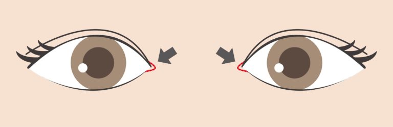什么是蒙古折？眼皮内眦和蒙古折是一回事吗？眼头眼尾改造手术简介