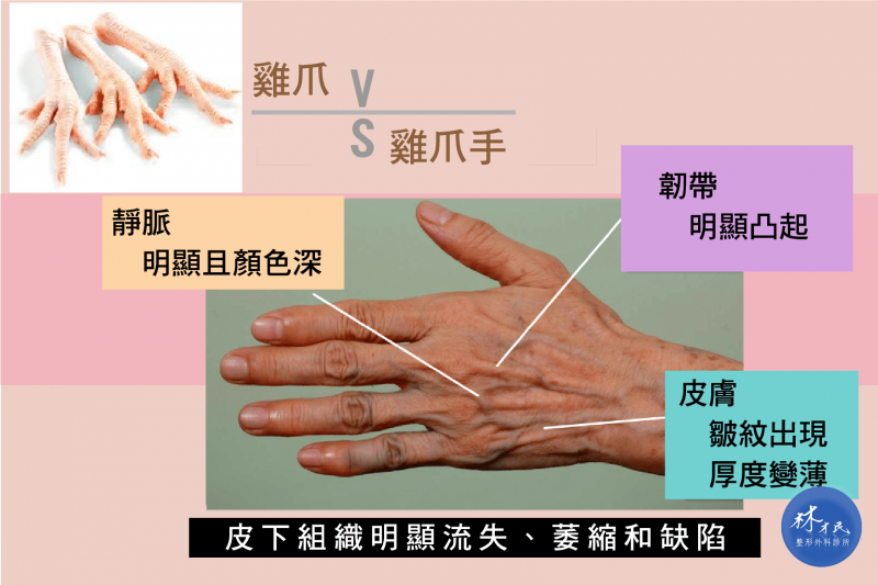 鸡爪手、巫婆爪、手背老化怎么办？手部保养很重要