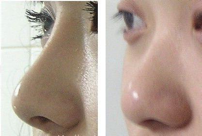 鼻综合整形能改善哪些鼻部缺陷