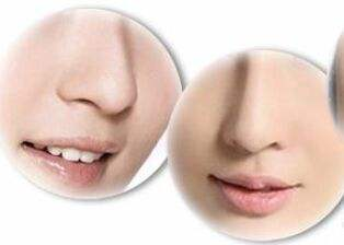 打造立体美鼻，隆鼻尖的方法有哪些