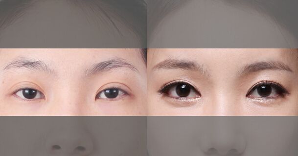 常见的双眼皮手术的优缺点