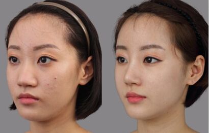隆鼻手术后多久可以化妆？