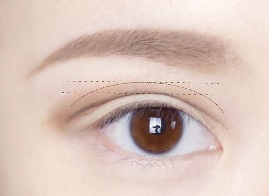 什么样眼型做双眼皮手术好看？专家告诉你！