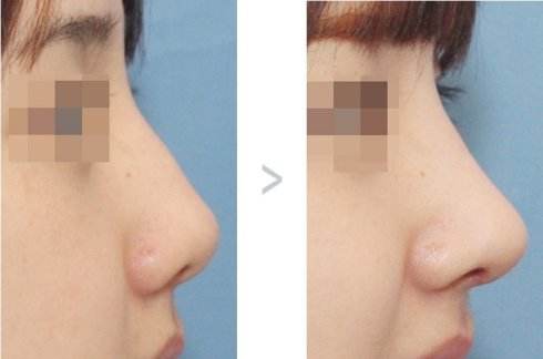 膨体隆鼻感染是什么症状？