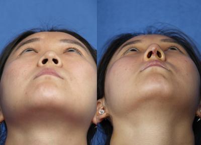 鼻尖整形修复注射隆鼻会有副作用吗？