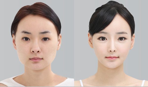 下颌角整形术有效改变脸型